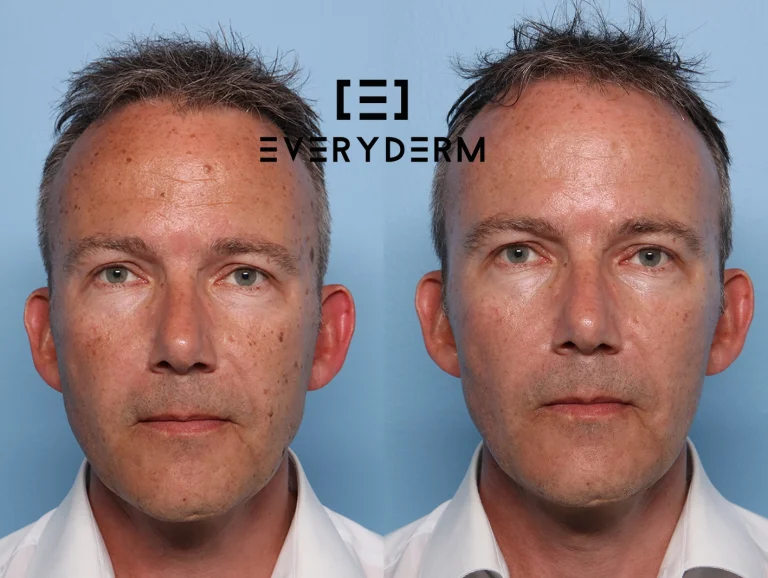 Before and after B&A1F Everyderm