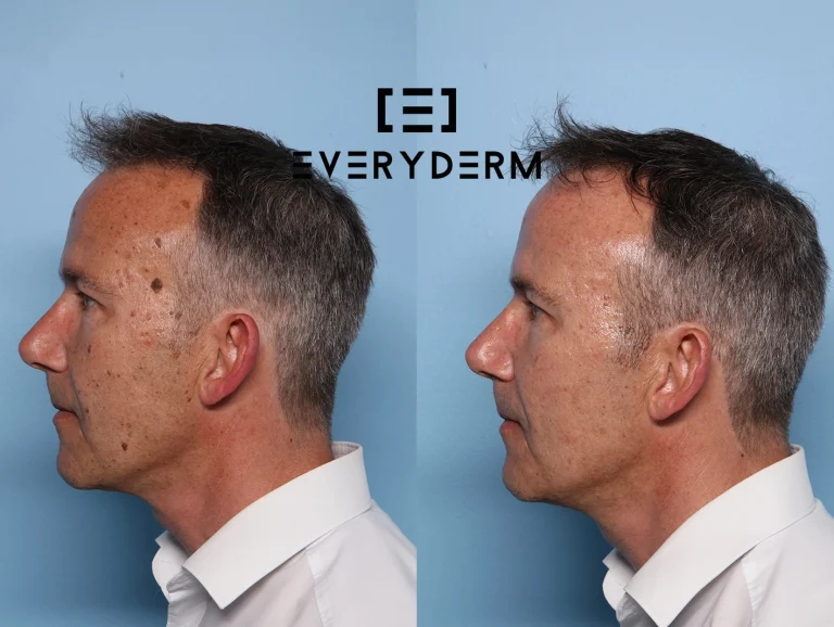 Before and after B&ALL Everyderm
