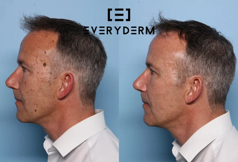 Before and after B&ALL Everyderm