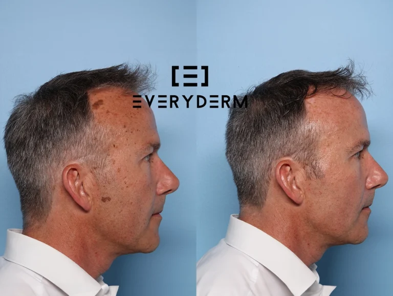 Before and after B&ARL Everyderm
