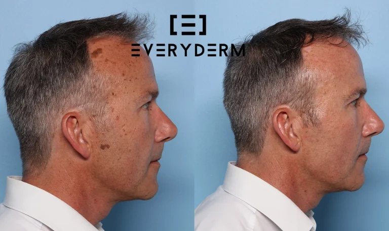Before and after B&ARL Everyderm