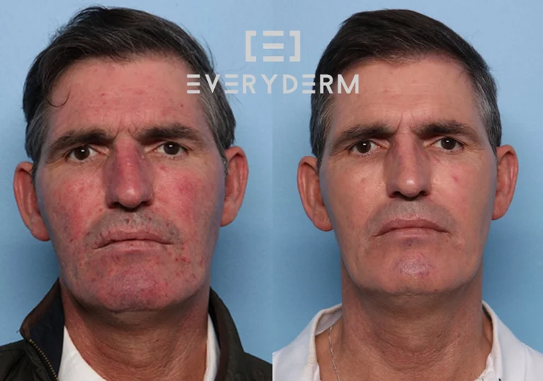 03 Before and After Analisiyng Everyderm