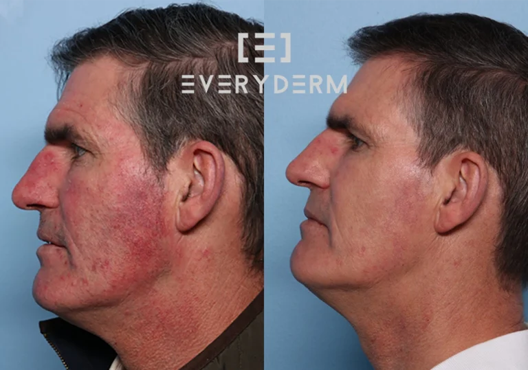 02 Before and After Analisiyng Everyderm