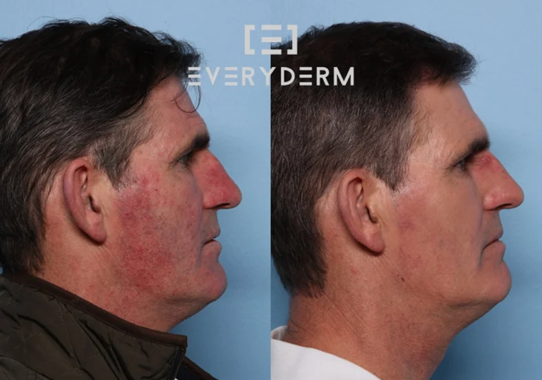 Before and After Analisiyng Everyderm