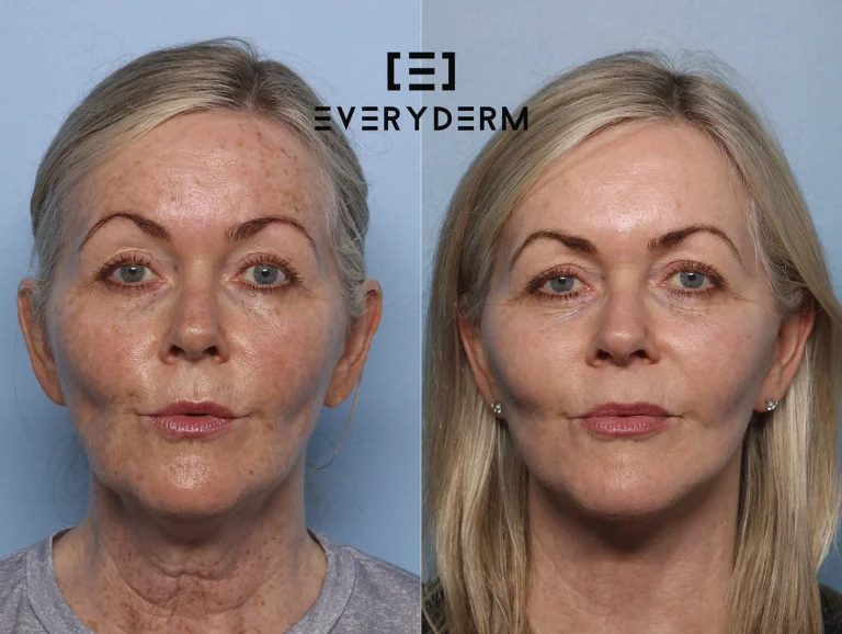 B&AF_GRAINNE_Everyderm