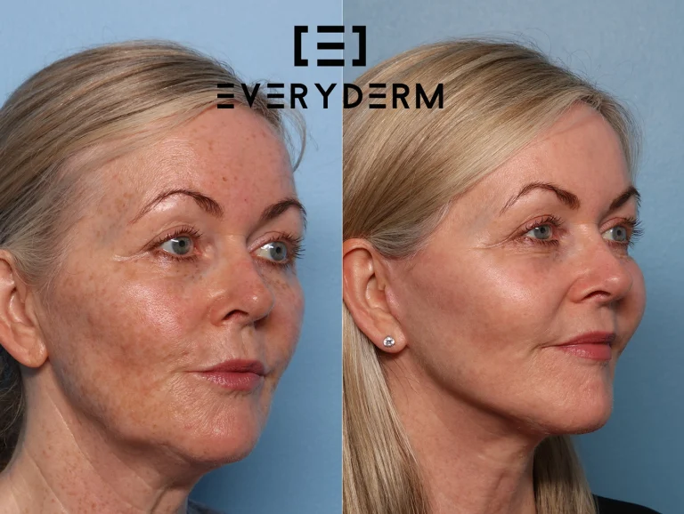 B&ARAO_GRAINNE_EVERYDERM