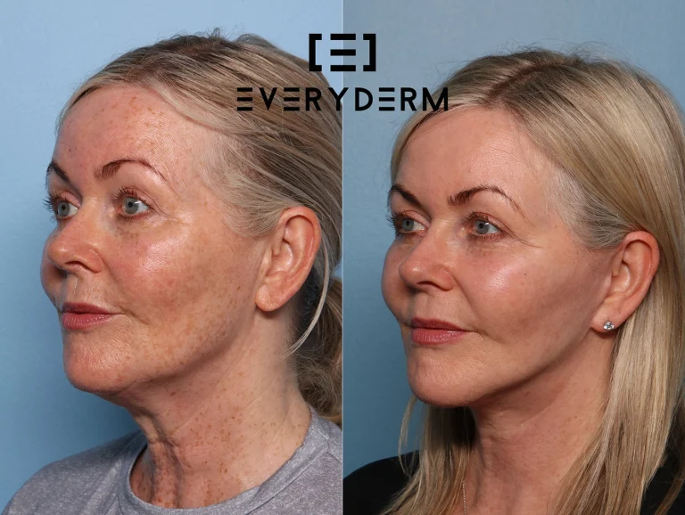 B&A_LAO_Grainne_Everyderm