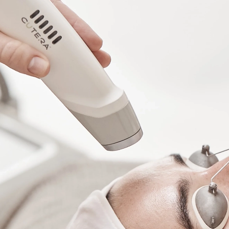 Everyderm_Photorejuvenation Treatment_Laser Genesis