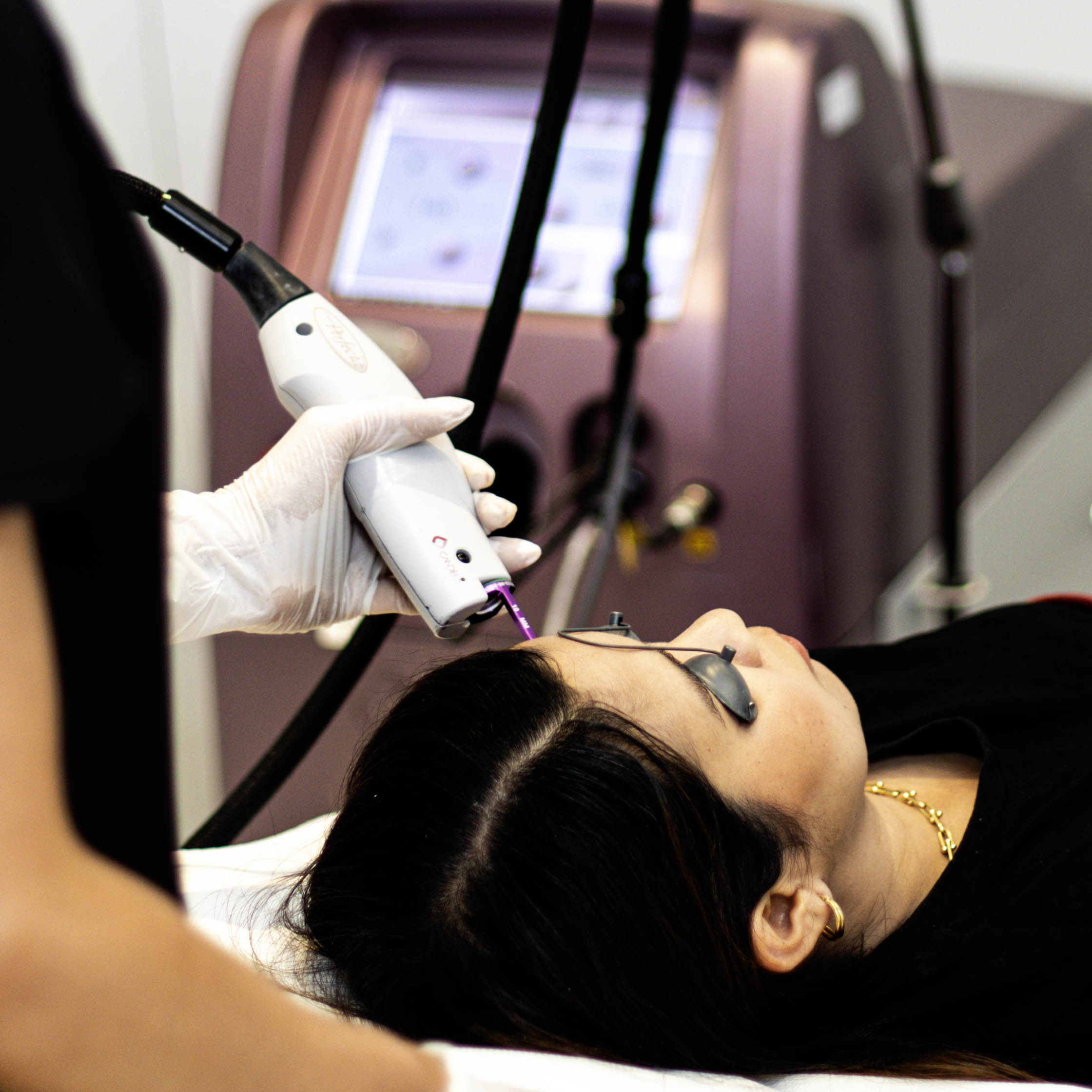VBeam Photorejuvenation